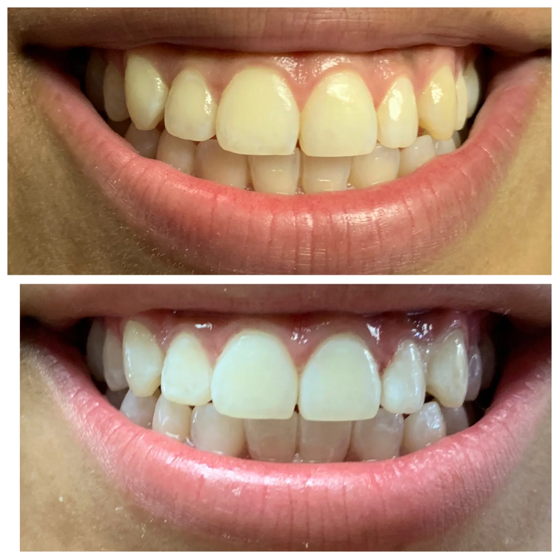 Blanqueamiento Dental Profesional